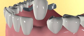 Адгезивный зубной протез