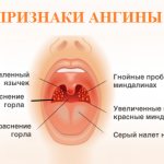 sore throat symptoms