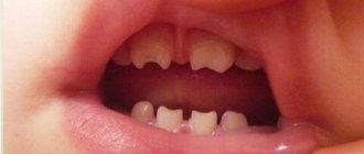 аномалии формы зубов