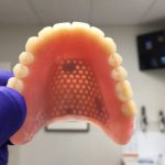 reinforcement of dentures