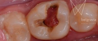 Аутотрансплантация - пересадка собственного зуба. Фото до удаления
