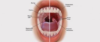 White spots in the throat: causes and treatment