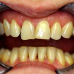 Безметалловые коронки на зубы - фото до лечения