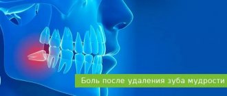 pain after wisdom tooth removal
