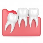 Painful symptoms from wisdom teeth