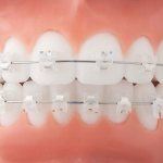Self-ligating and ligature braces: what is the difference and which is better