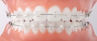 Self-ligating and ligature braces: what is the difference and which is better