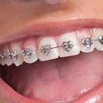 braces teeth bite