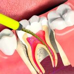 Чистка канала зуба
