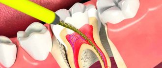 Чистка канала зуба