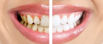 Teeth cleaning with Air Flow or ultrasound: which is better?