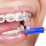 Brushing your teeth while wearing braces