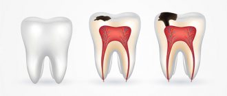 What to do if the enamel on your teeth is worn away?