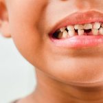 What to do if a child’s enamel peels off?