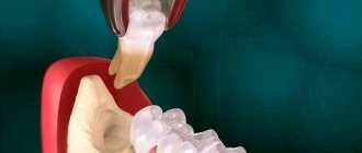 Что делать после удаления зуба
