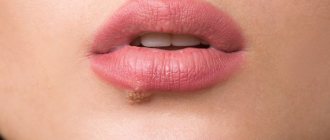 What to do if papilloma appears on the lips