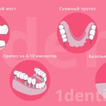 What can be put in place of an extracted tooth?