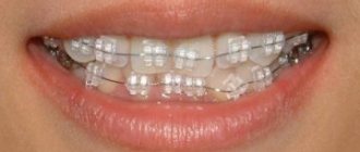 what are inspire ice sapphire braces, their photos