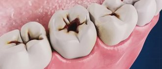 What is caries and how to treat it, North-Eastern Dental Center No. 1