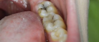 what is caries and how does it develop?