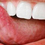 what is macroglossia and how is it dangerous?