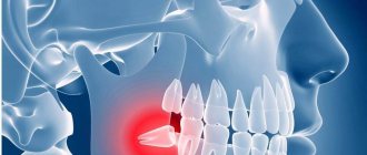 What is complex wisdom tooth extraction?