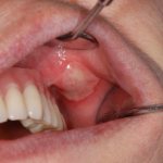 Decumbital ulcer in the mouth