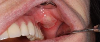 Декумбитальная язва в полости рта