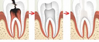 Tooth removal and prosthetics