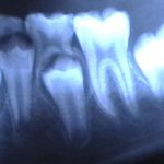 children&#39;s dental x-ray