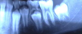 детский рентген зуба
