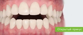 distal occlusion of teeth