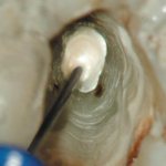 Длительная экспозиция гидроксида кальция во фронтальных зубах верхней челюсти (клинический случай)