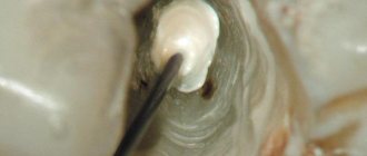 Длительная экспозиция гидроксида кальция во фронтальных зубах верхней челюсти (клинический случай)