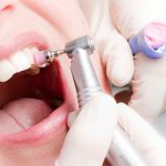 why do you need professional teeth cleaning photo