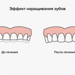 The effect of teeth extensions in pictures