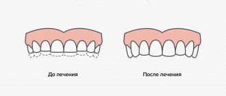 The effect of teeth extensions in pictures