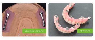 elements of removable dentures on implants