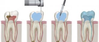Endodontic root canal treatment