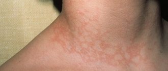 Erythema