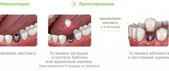 этапы имплантации одного зуба ROOTT