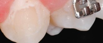Stages of caries development under braces