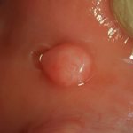 fibroma in the mouth