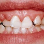 fibromatosis of the gums