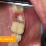 Photo of white plaque on the wound after tooth extraction