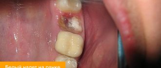Photo of white plaque on the wound after tooth extraction