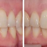 Photos before and after treatment with lingual braces