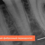 Photo of chronic fibrous periodontitis