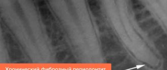 Photo of chronic fibrous periodontitis