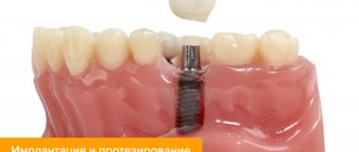 Photo of an implant that is replaced with a crown